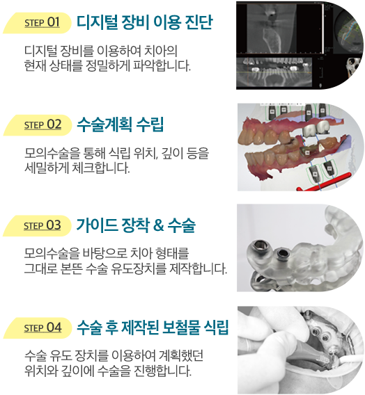 STEP 01 디지털 장비 이용 진단 - 디지털 장비를 이용하여 치아의 현재 상태를 정밀하게 파악합니다. STEP 02 수술계획 수립 - 모의수술을 통해 식립 위치, 깊이 등을 세밀하게 체크합니다. STEP 03 가이드 장착 & 수술 - 모의수술을 바탕으로 치아 형태를 그대로 본뜬 수술 유도장치를 제작합니다. STEP 04 수술 후 제작된 보철물 식립 - 수술 유도 장치를 이용하여 계획했던 위치와 깊이에 수술을 진행합니다.
