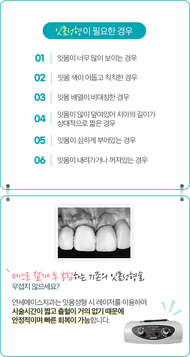 잇몸성형이 필요한 경우 - 01 잇몸이 너무 많이 보이는 경우 / 02 잇몸 색이 어둡고 칙칙한 경우 / 03 잇몸 배열이 비대칭한 경우 / 04 잇몸이 많이 덮여있어 치아의 길이가 상대적으로 짧은 경우 / 05 잇몸이 심하게 부어있는 경우 / 06 잇몸이 내려가거나 꺼져있는 경우. 메스로 절개 후 봉합하는 기존의 잇몸성형술 무섭지 않으세요? 연세에이스치과는 잇몸성형 시 레이저를 이용하여 시술시간이 짧고 출혈이 거의 없기 때문에 안정적이며 빠른 회복이 가능합니다.