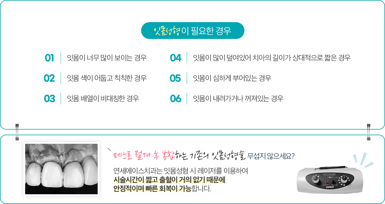 잇몸성형이 필요한 경우 - 01 잇몸이 너무 많이 보이는 경우 / 02 잇몸 색이 어둡고 칙칙한 경우 / 03 잇몸 배열이 비대칭한 경우 / 04 잇몸이 많이 덮여있어 치아의 길이가 상대적으로 짧은 경우 / 05 잇몸이 심하게 부어있는 경우 / 06 잇몸이 내려가거나 꺼져있는 경우. 메스로 절개 후 봉합하는 기존의 잇몸성형술 무섭지 않으세요? 연세에이스치과는 잇몸성형 시 레이저를 이용하여 시술시간이 짧고 출혈이 거의 없기 때문에 안정적이며 빠른 회복이 가능합니다.