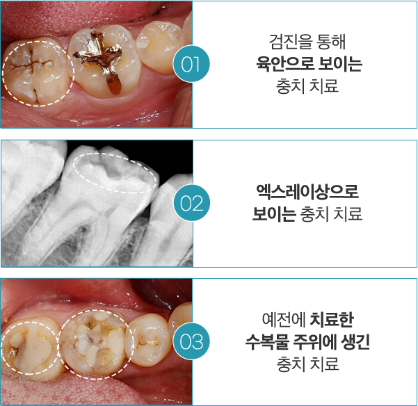 01 검진을 통해 육안으로 보이는 충치 치료 / 02 엑스레이상으로 보이는 충치 치료 / 03 예전에 치료한 수복물 주위에 생긴 충치 치료