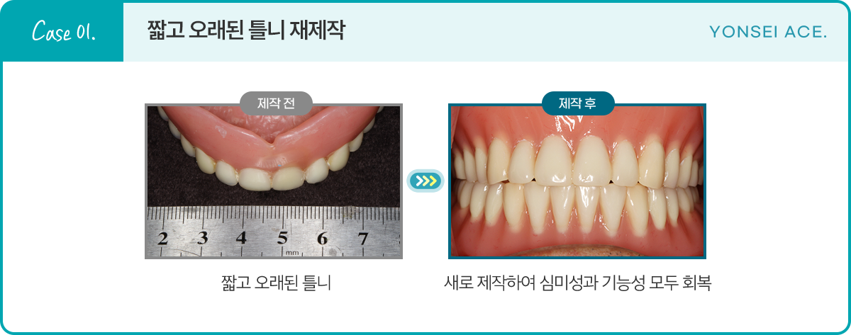 Case 01. 짧고 오래된 틀니 재제작